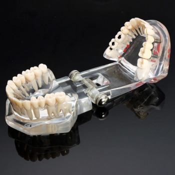 Lehrzahnerkrankungen Zähne Implantation Modell 