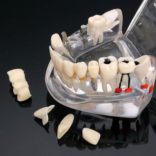 Lehrzahnerkrankungen Zähne Implantation Modell 